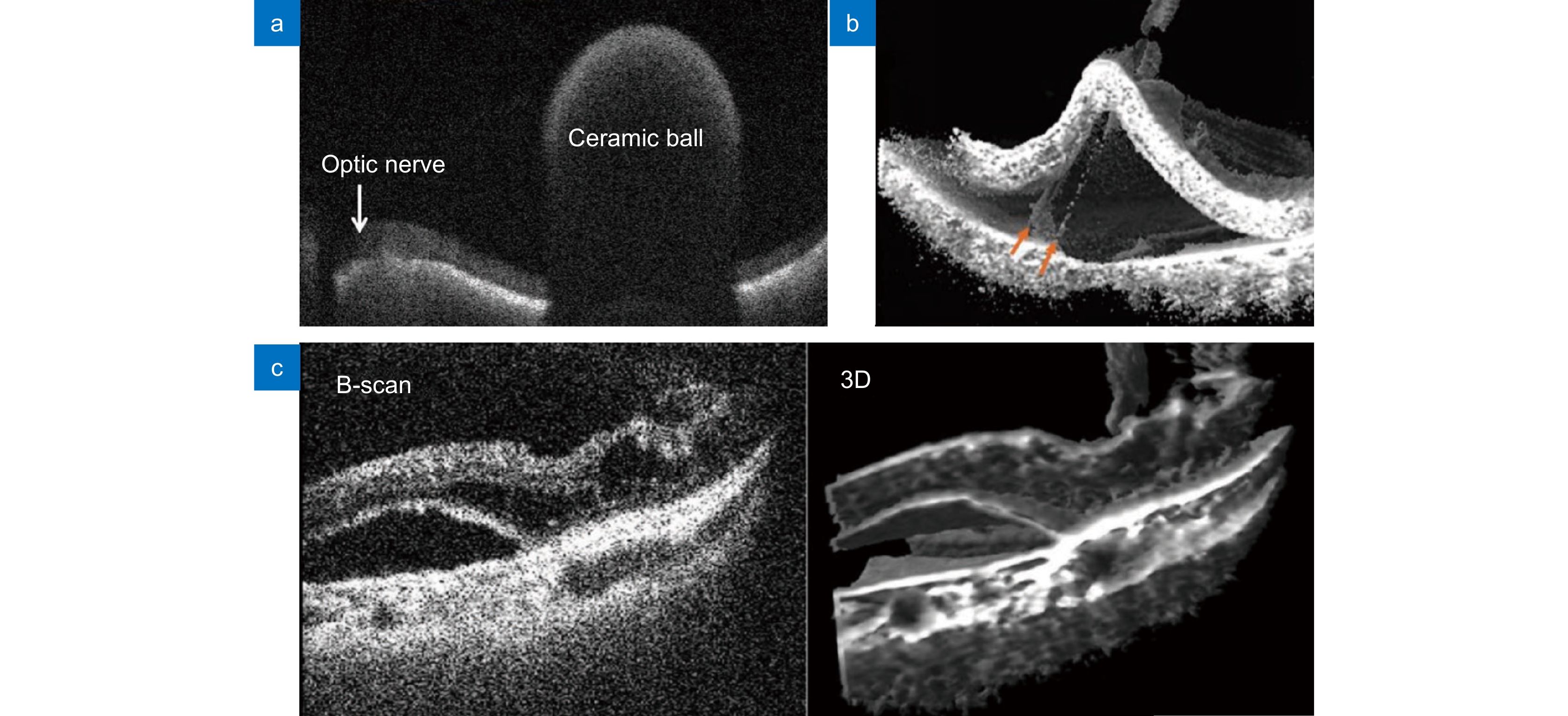 4D MIOCT实时成像。(a) 观测视网膜上的陶瓷球体[82]；(b) 手术工具抓取视网膜色素上皮细胞层的实时图像[83]；(c)  玻璃体切除术中视网膜下积液的二维和三维图像[84]